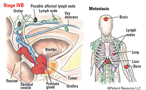 Prostate Cancer Advanced Staging